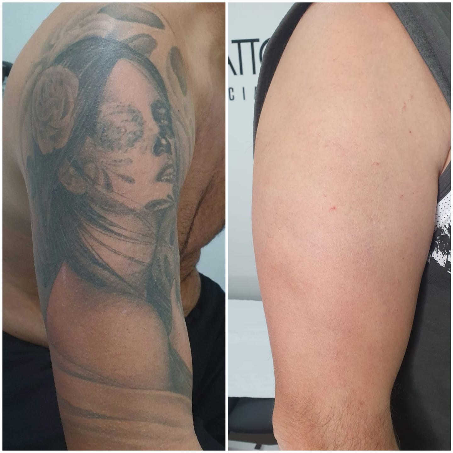 Laser Tattoo, Eliminación de Tatuajes en Barcelona